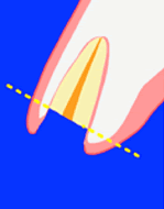エクストリュージョン
