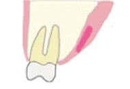 エクストリュージョン