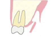 エクストリュージョン