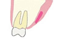 エクストリュージョン